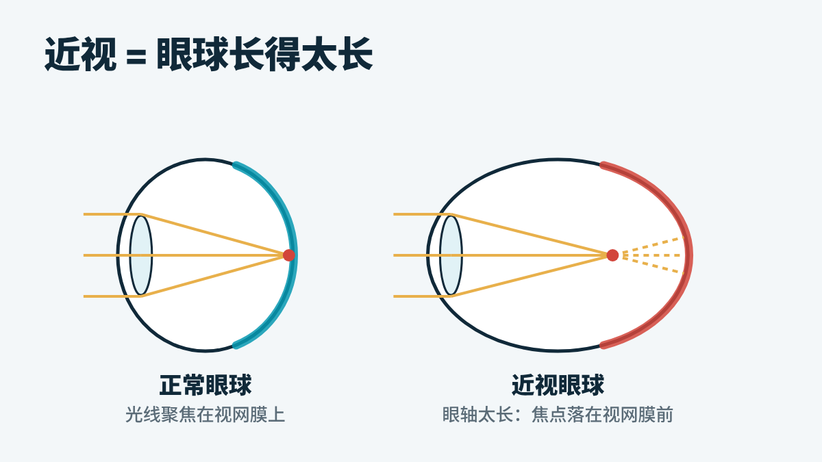 正常眼球与眼轴过长的近视眼球示意图